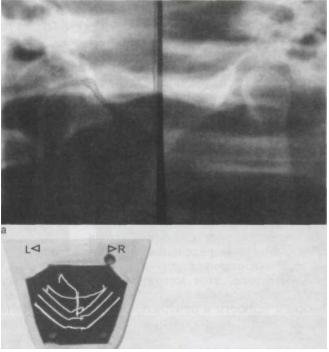 artrózis 2 fokos ok és kezelés milyen kenőcs a nyaki gerinc osteochondrozisának kezelésére
